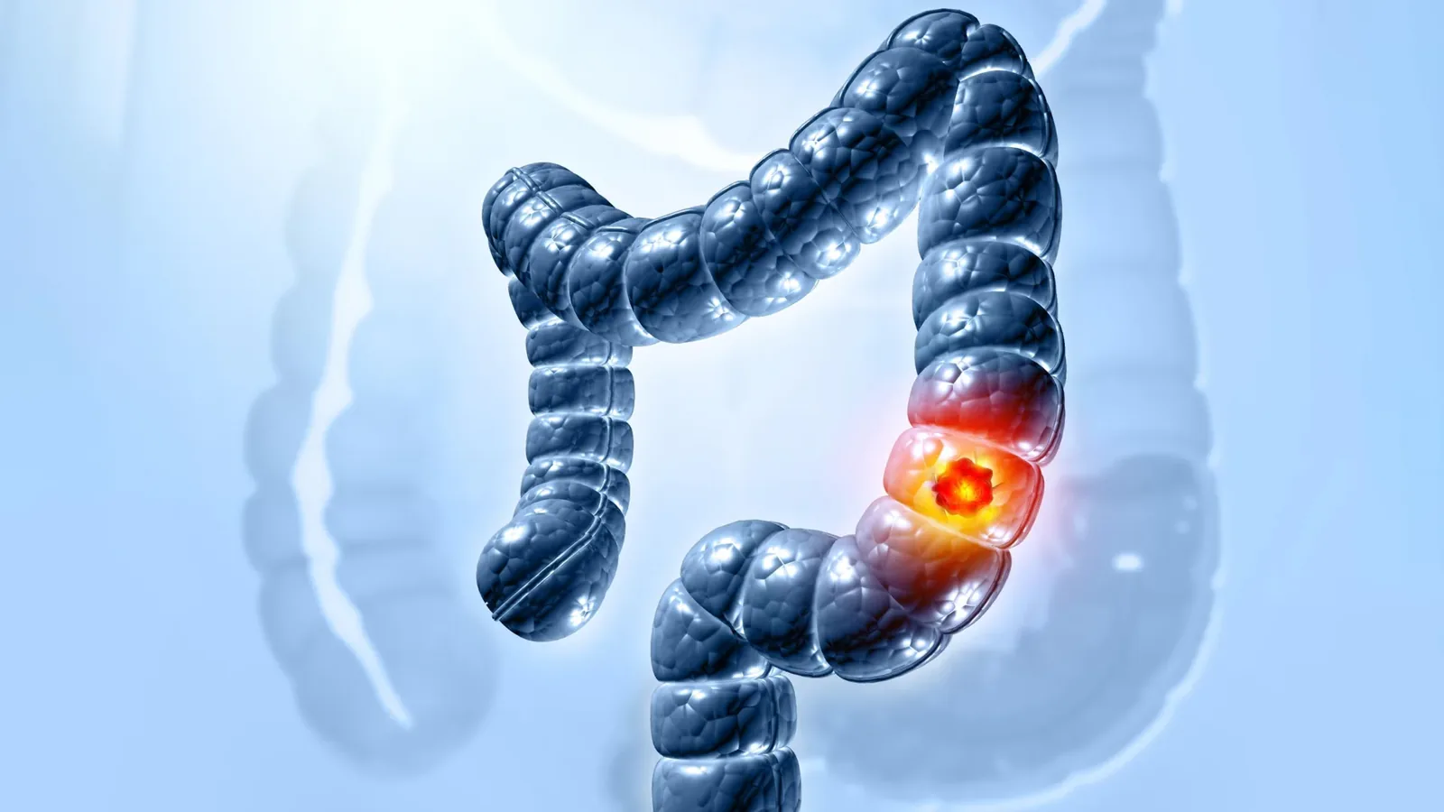 Heavy Lifetime Alcohol Use Boosts Rectal Cancer Risk
