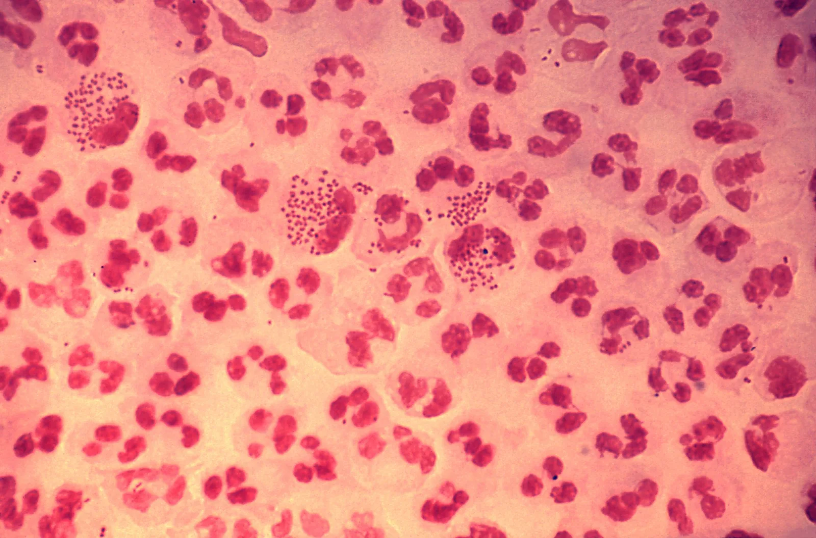 Trial Reveals Meningococcal B Vaccine Ineffective Against Gonorrhea